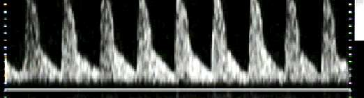 ARTERIA CEREBRALE MEDIA (MCA) IPOSSIA CRONICA REIDRISTIBUZIONE FLUSSO Vasocostrizione distretto splancnico ( PI UA) VASODILATAZIONE CEREBRALE PI MCA(max po2