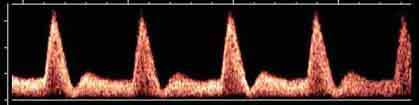 ARTERIE UTERINE Sistema vascolare a BASSARESISTENZA PARAMETRI First-trimester uterine artery Doppler indices in the prediction of small-for-gestational age pregnancy and intrauterine growth