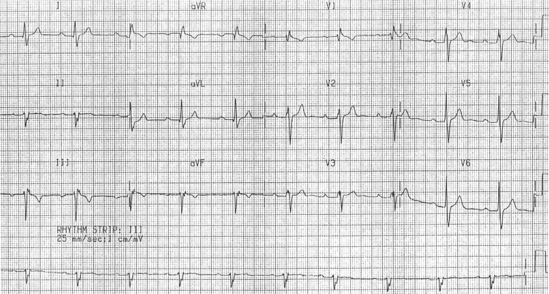 Capitolo 8 Difetti del setto interatriale e anomalie dei ritorni venosi polmonari 77 Figura 8.2 Elettrocardiogramma a 12 derivazioni di un paziente con una comunicazione interatriale.