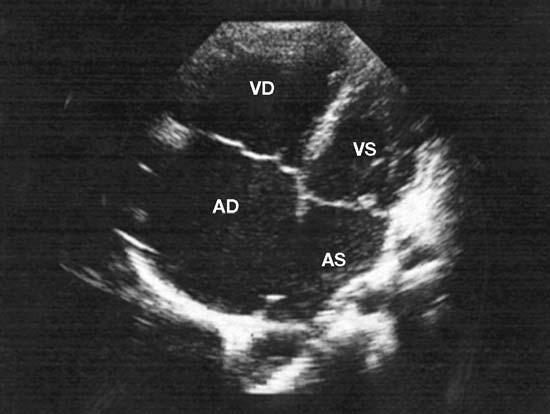 78 Cardiopatie congenite Figura 8.3 Ecocardiogramma transtoracico di un paziente con ampio difetto interatriale tipo ostium secundum.