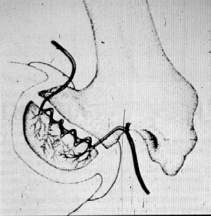 Necrosi asettica epifisaria morbo di Legg-Calvè-Perthes Probabile osteocondrosi Malattia su base ischemica che si realizza nell età evolutiva Caratterizzata da fenomeni necrotici che esitano nello