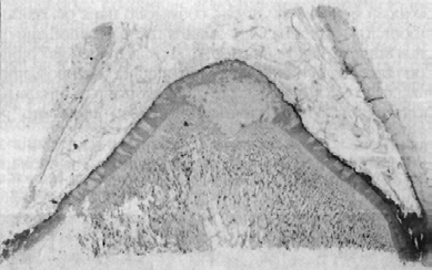 Ritenzione della cartilagine encondrale Lesione frequente nei cani di grande taglia con localizzazione preminente al disco epifisario distale dell ulna, caratterizzata, come in tutte le lesioni