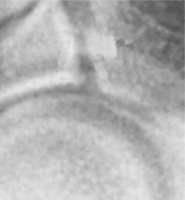 Incongruenza articolare Spezzatura della continuità della linea articolare radioulnare nel gomito Neoplasie primitive Neoplasie ossee Benigne