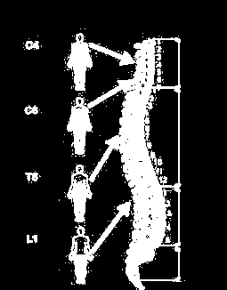 IL TRAUMA RACHIDEO - SPINALE TRAUMA RACHIDEO È il trauma a carico del rachide, ovvero della parte vertebrale.