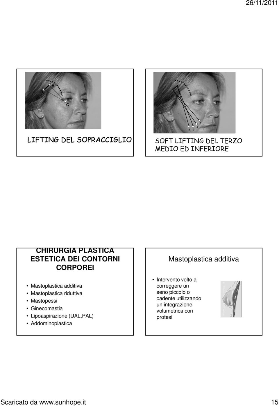 Ginecomastia Lipoaspirazione (UAL,PAL) Addominoplastica Mastoplastica additiva Intervento volto a