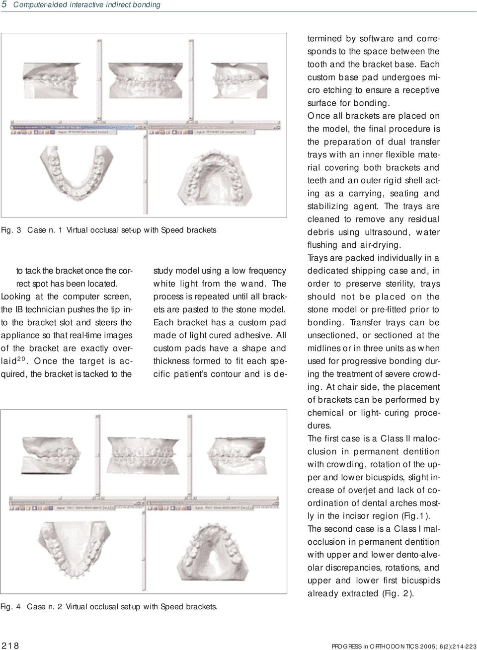 Once the target is acquired, the bracket is tacked to the Fig. 4 Case n. 2 Virtual occlusal set-up with Speed brackets. study model using a low frequency white light from the wand.