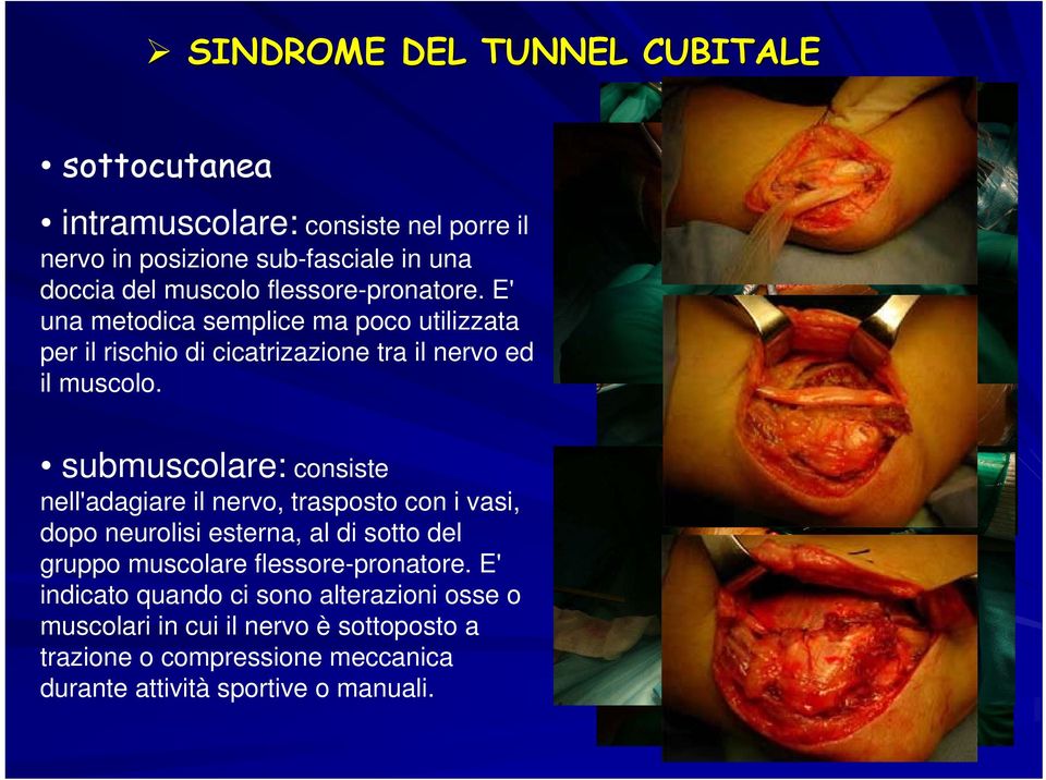 submuscolare: consiste nell'adagiare il nervo, trasposto con i vasi, dopo neurolisi esterna, al di sotto del gruppo muscolare