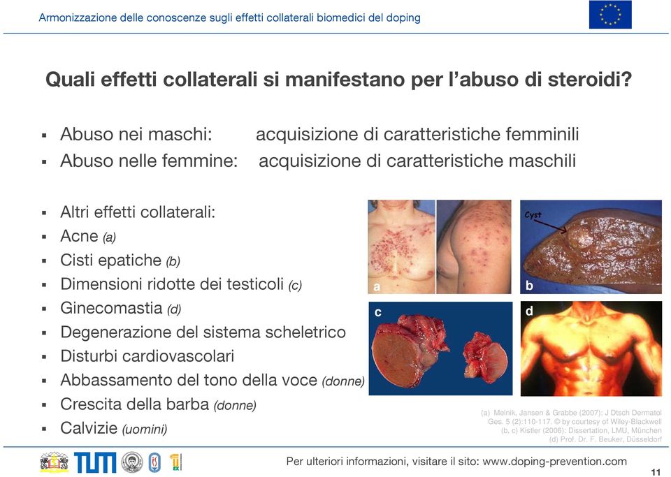 Cisti epatiche (b) Dimensioni ridotte dei testicoli (c) Ginecomastia (d) Degenerazione del sistema scheletrico Disturbi cardiovascolari Abbassamento del tono