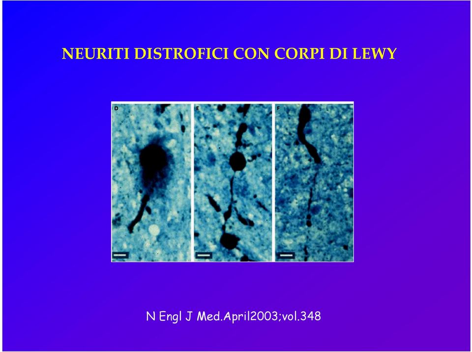 CORPI DI LEWY N