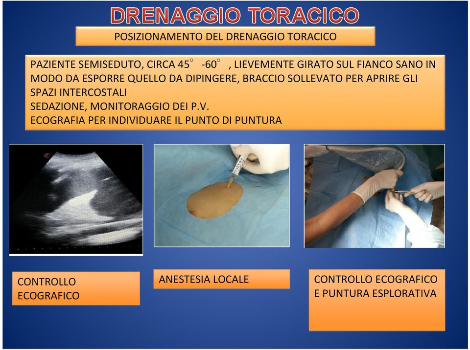 SPAZI INTERCOSTALI SEDAZIONE, MONITORAGGIO DEI P.V.