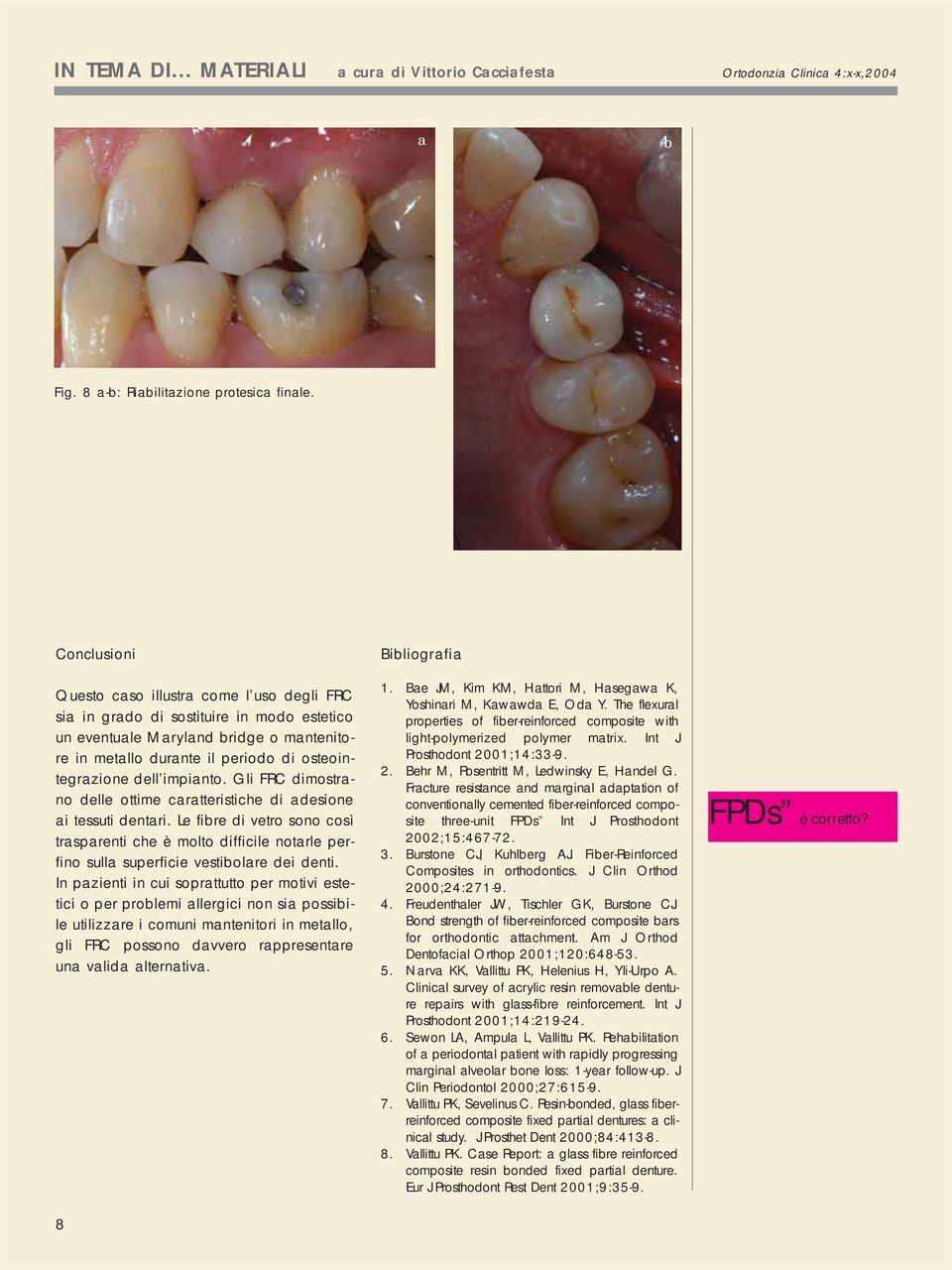 Gli FRC dimostrno delle ottime rtteristihe di desione i tessuti dentri. Le fire di vetro sono osì trsprenti he è molto diffiile notrle perfino sull superfiie vestiolre dei denti.