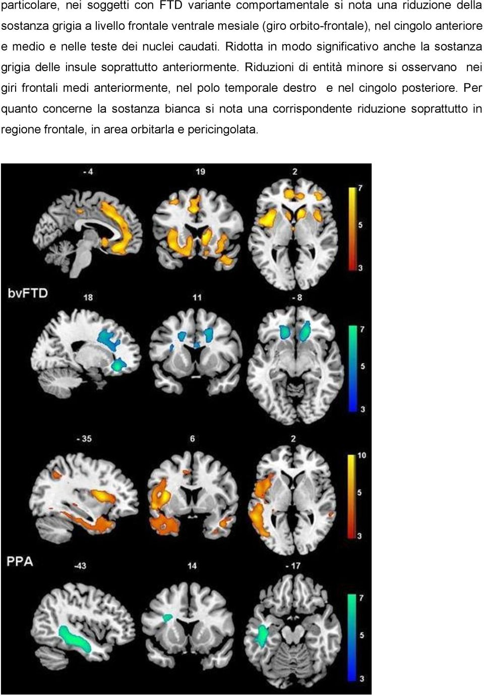 Ridotta in modo significativo anche la sostanza grigia delle insule soprattutto anteriormente.