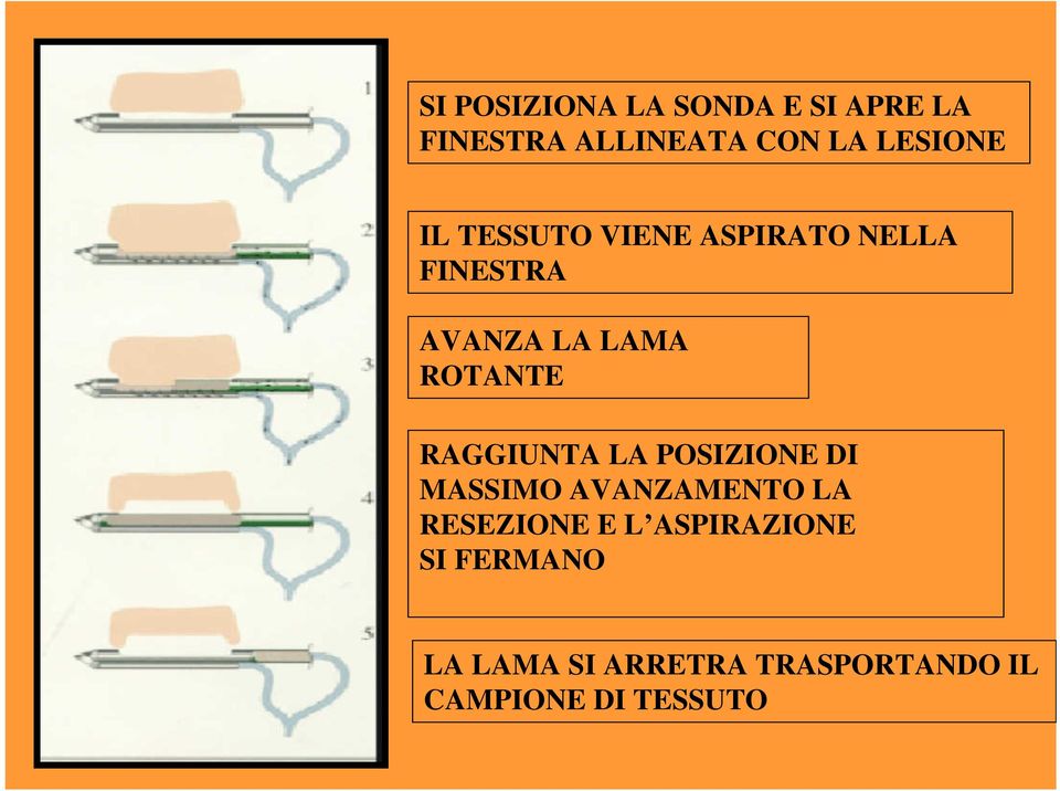 RAGGIUNTA LA POSIZIONE DI MASSIMO AVANZAMENTO LA RESEZIONE E L