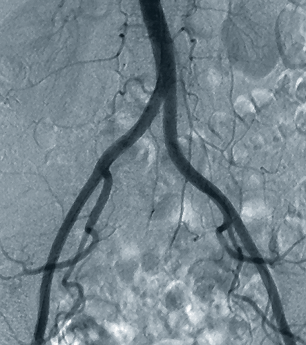 Un ampia scelta di applicazioni fluoroscopiche Fluoroscopia del tratto gastro-intestinale inferiore Angiografia Apollo EZ permette di eseguire lo studio del tratto gastro-intestinale inferiore