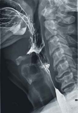 SISTEMA RF TELECOMANDATO 90/30 ottenibili con facili procedure Studio e valutazione radiografica della funzionalità esofagea Proiezione Latero-Laterale Proiezione Latero-Laterale: lo studio dinamico