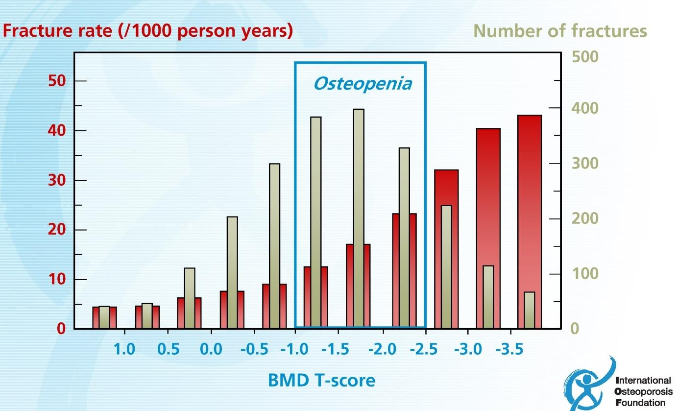 FRATTURE OSTEOPOROTICHE E DENSITÀ MINERALE