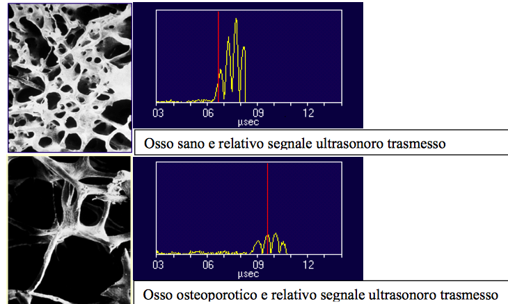 METODICHE DENSITOMETRICHE: QUS Ultrasonografia Ossea Quantitativa Metodica di misurazione della densità minerale ossea: relativamente semplice, poco costosa, facile da attuare, trasportabile e che