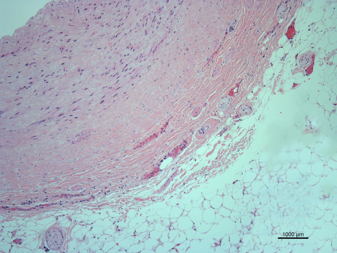 Localizzazione anatomica dei nervi simpatici renali Nascono da T10-L1 Seguono l arteria