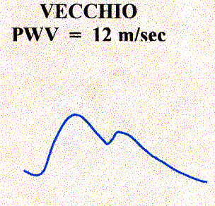 Apertura valvola aortica