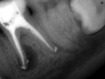 L INFORMATORE ENDODONTICO Vol. 12, Nr. 1 2009 Fig. 3. Caso clinico trattato con l utilizzo di un solo Twisted File. Fig. 4. Caso clinico ritrattato con l utilizzo di due Twisted File.