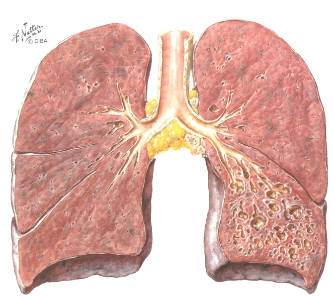 : patogenesi INFEZIONE OSTRUZIONE Distruzione ciglia, mucosa, f.