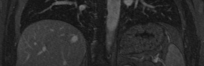Tromboembolia b polmonare risonanza magnetica non invasiva no radiazioni ionizzanti elevata risoluzione di contrasto non