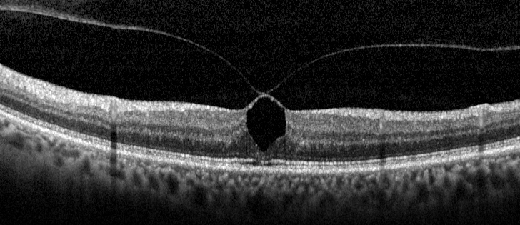 1.2 Trazione vitreo-maculare E un anomalo PVD caratterizzato da una forte aderenza del vitreo alla fovea Provoca alterazioni anatomiche (ed è quindi sintomatico) Non è associato ad una interruzione a