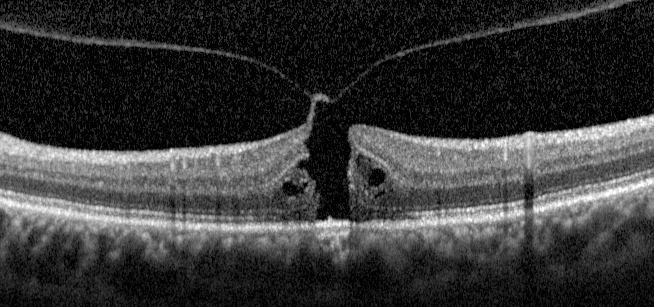 2 Foro maculare E un foro a tutto spessore della fovea Normalmente generato da un distacco posteriore di