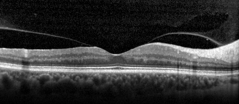 1.1 Aderenza del vitreo alla macula Deriva da un distacco posteriore di vitreo a tutto spessore ma non completo, la corteccia vitreale si distacca dalla periferia ma rimane