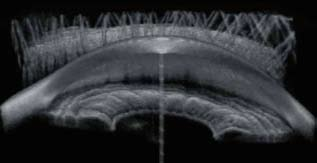 Nella visualizzazione in 3D potete vedere l immagine come attraverso una lente gonioscopica, anche in rotazione. Schermata con le immagini dell'esame.