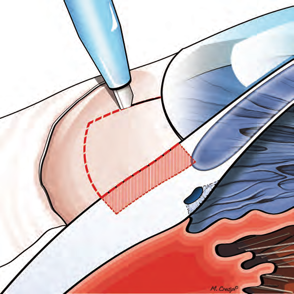 Fig. 3.3. Preparazione del letto sclerale Fig. 3.4.