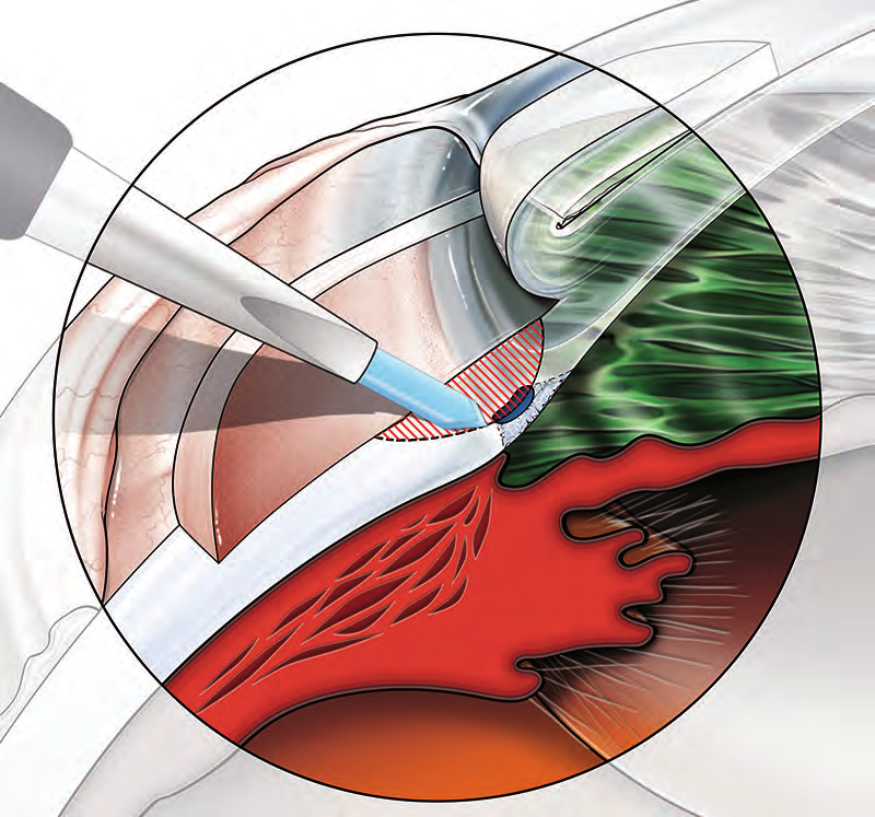 Fig. 7.1A Creazione dell incisione radiale del limbus per l identificazione del canale di Schlemm (visione del chirurgo). Fig. 7.1B Creazione dell incisione radiale del limbus per l identificazione del canale di Schlemm (visione laterale).