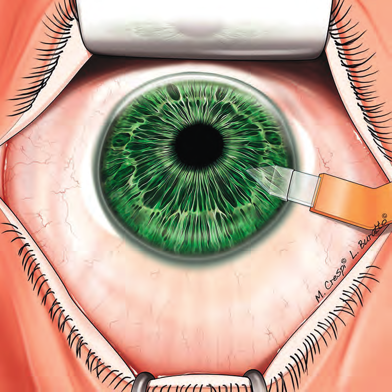 Fig.11.9 CyPass Micro-Stent. Fig.11.10 Incisione corneale.
