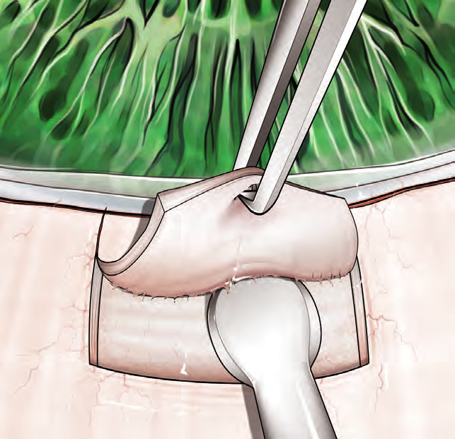 Fig.6.5. Scolpitura del tunnel corneo-sclerale. Fig.6.6. Bulbo afachico sottoposto a vitrectomia con olio di silicone e iridectomia di Ando.