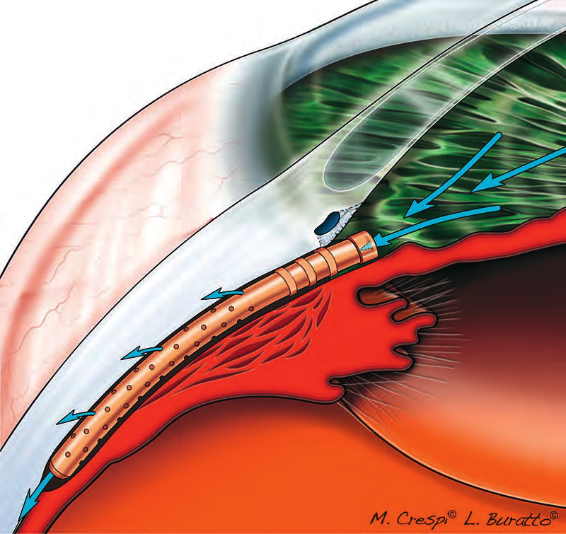 Fig.11.19 Meccanismo di azione del CyPass Micro-Stent.