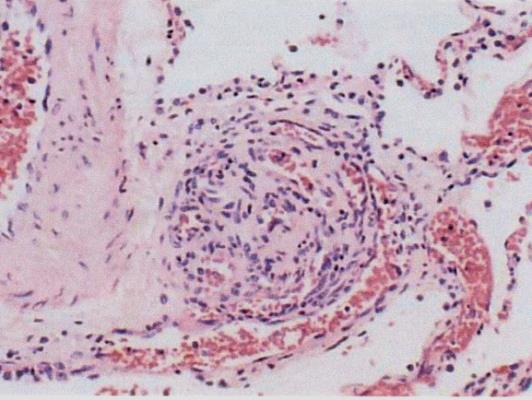 Ipertensione Polmonare Cronica Tromboembolica (IPCTE