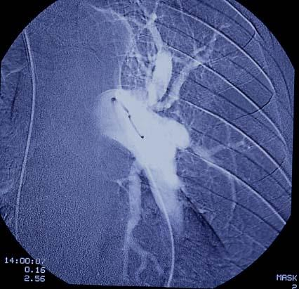 CHRONIC THROMBOEMBOLIC PULMONARY HYPERTENSION: SURGICAL TREATMENT P.A. 66 yrs M Jun 2001 PEA #60 Before PEA 3 months mpap 50 15 CI 1.