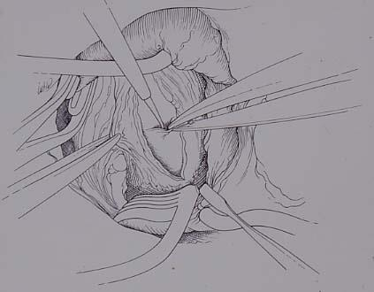 CHRONIC THROMBOEMBOLIC PULMONARY HYPERTENSION: SURGICAL TREATMENT TYPE OF OPERATION Median sternotomy Cardio Pulmonary Bypass Deep hypotermia