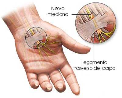 SINDROME DEL TUNNEL CARPALE Sintomi Dolore e