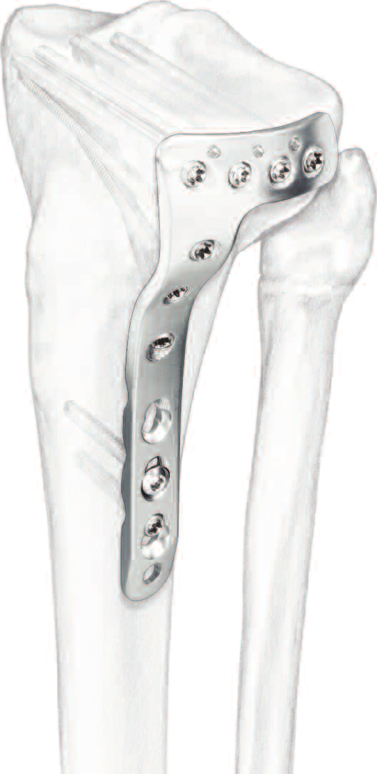 Placca LCP da 3.5 per tibia prossimale. Parte integrante del Sistema di Piccoli Frammenti LCP Synthes.