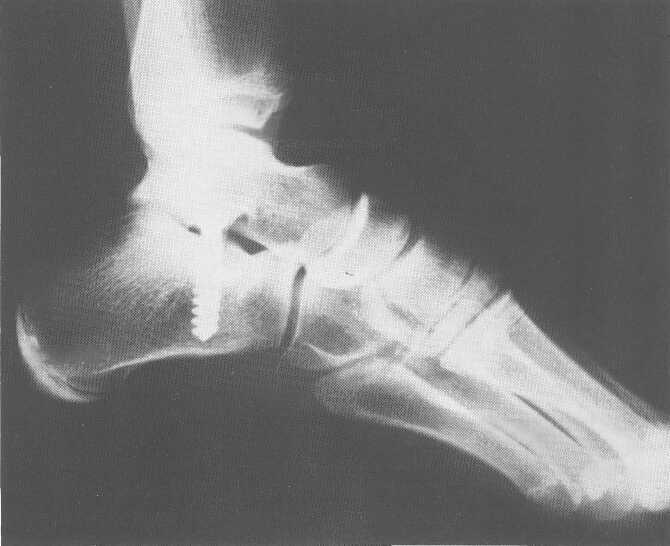 L'artrorisi astragalica nel trattamento del piede piatto del tarso di una vite da spongiosa con direzione obliqua postero-anteriore, dorso-plantare e dall'esterno all'interno in modo che la testa
