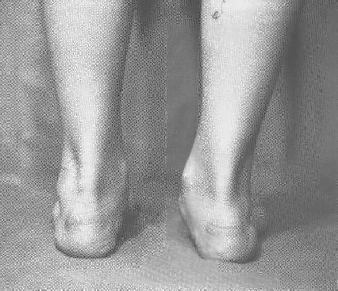 L'artrorisi astragalica nel trattamento del piede piatto Fig.