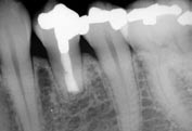 L Informatore Endodontico Vol. 6, Nr. 3 2003 7a 7c 7b 7d Figura 7a Radiografia preoperatoria del primo premolare inferiore sinistro. La precedente chirurgia non ha avuto buon esito.