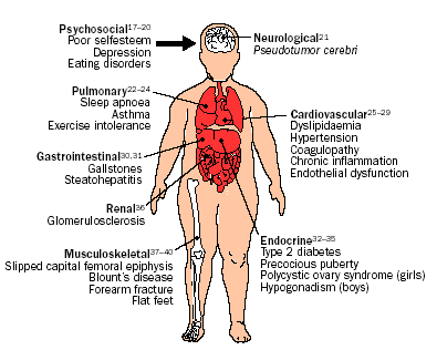 Ebbeling CB et al, Lancet 2002 Complicanze dell Obesita Psicosociali Scarsa stima di sé Depressione Polmonari Sleep apnea Asma Intolleranza all esercizio Gastrointestinali Calcolosi colecistica