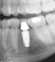 La sistematica LE POSSIBILITA PROTESICHE TissueCare Concept ANKYLOS I cinque fattori di successo del TissueCare Concept: 1. Nessun micromovimento fra impianto e sovrastruttura protesica 2.