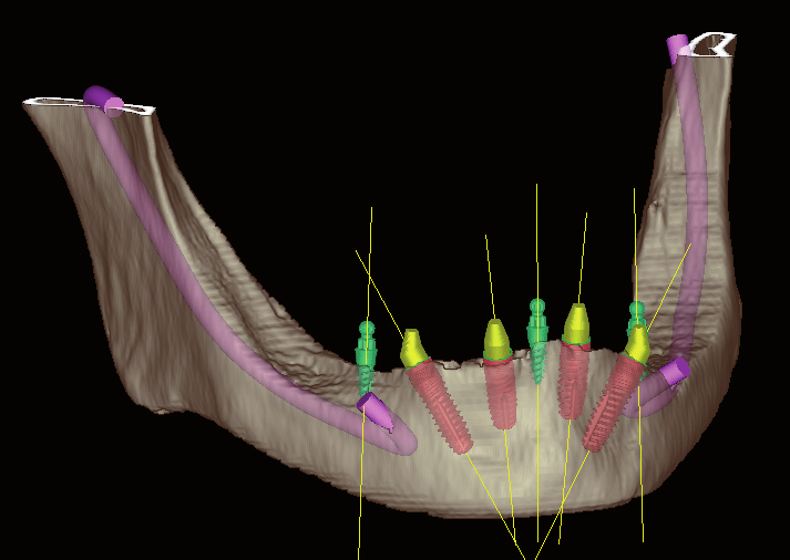 Il sistema di pianificazione implantare 3D comprende i seguenti componenti: minisky x-resin Punti fissi di riferimento Un impianto di diametro ridotto, monocomponente Impianto (lunghezza 6 + 10 mm)