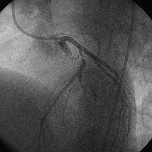 VERO POSITIVO Paziente maschio, età 40 anni, familiarità per coronaropatia, forte fumatore, dolore toracico retrosternale. All ECG ritmo sinusale con FC=60 bpm.