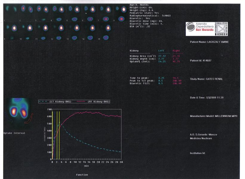 L.A. maschio, 4aa, pakistano A dx: Curva nefroscintigrafica in accumulo,non migliora ne con stimolo diuretico, ne dopo