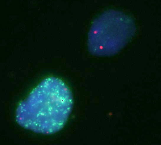 c-myc: carcinomi della mammella, del colon, dei polmoni ed altri