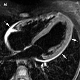 Fig.7 - a sinistra (c,d) sequenze T2 pesate con soppressione del tessuto adiposo in cui si evidenziano i foglietti pericardici ispessiti e sede di processo flogistico. A dx sequenze di LGE (b,a).